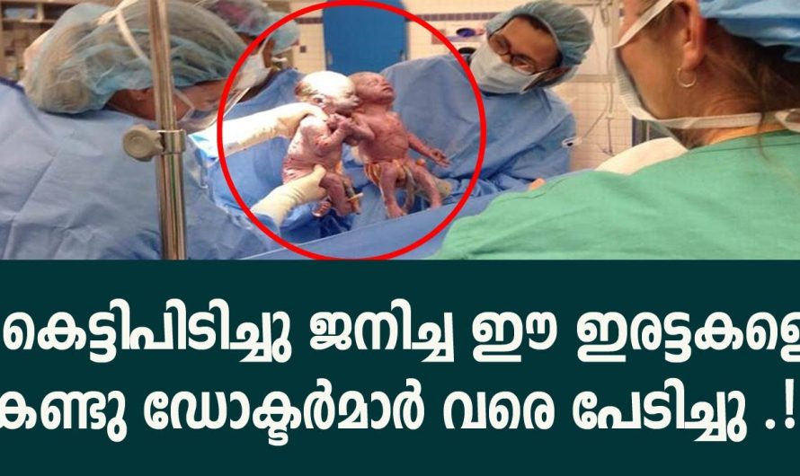 ഡോക്ടർമാർ വരെ കെട്ടിപിടിച്ചു ജനിച്ച ഈ ഇരട്ടകളെ കണ്ടു പേടിച്ചു, പിന്നെ നടന്നത്