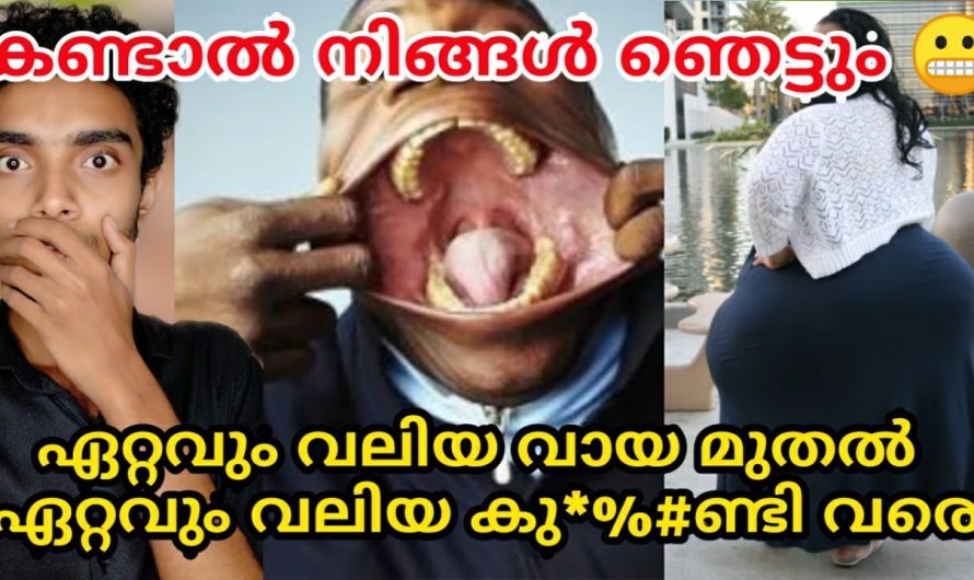 ശരീരഭാഗങ്ങളുടെ വളർച്ചകൊണ്ട് വ്യത്യസ്തരായ ചില മനുഷ്യരെ കുറിച്ച് പരിചയപ്പെടാം…