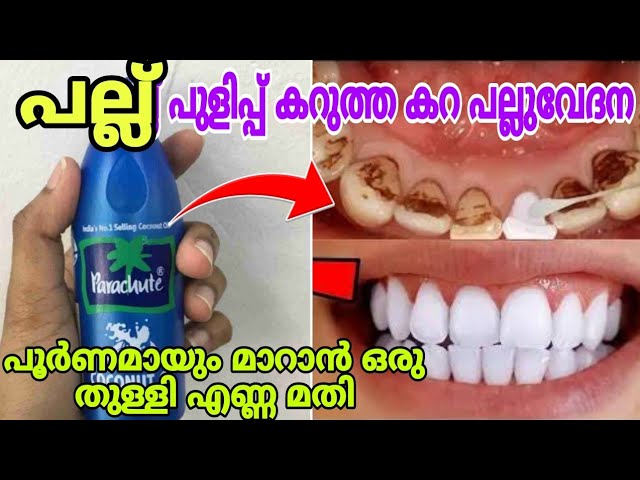 പല്ലുകളിൽ ഉണ്ടാവുന്ന ഏത് പ്രശ്നവും മാറാൻ ഈ ഒരൊറ്റ ടിപ്സ് മതി..