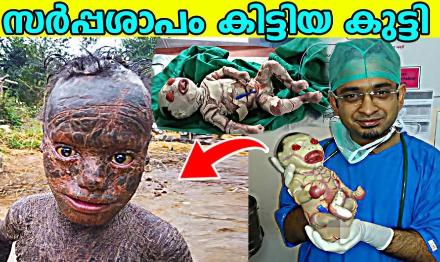വിചിത്രമായ ശരീരഘടനകൾ കൊണ്ട് ഭൂമിയിൽ ജനിച്ച ചില വ്യത്യസ്ത മനുഷ്യരെ കുറിച്ച് പരിചയപ്പെടാം..