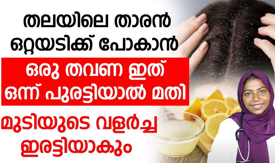 താരൻ പ്രശ്നം കാരണം ബുദ്ധിമുട്ടുന്നവരാണ് നിങ്ങളെങ്കിൽ ഈ വീഡിയോ ഉപകാരപ്പെടും..