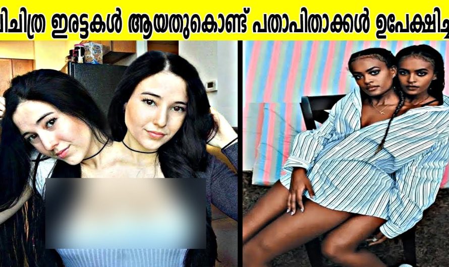 രണ്ടു തലയും ഒരു ശരീരവുമായി ജീവിക്കുന്ന ഇരട്ടകൾ